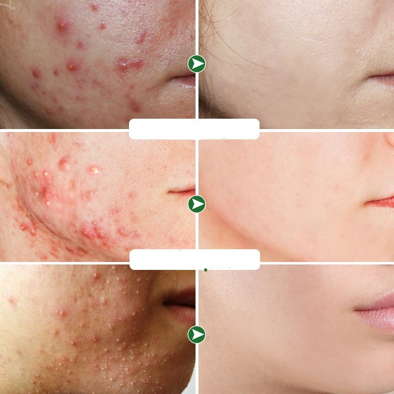 Acne creme facial