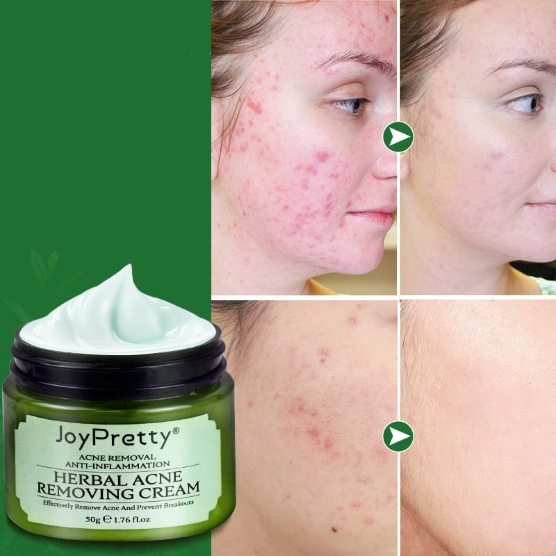 Acne creme facial